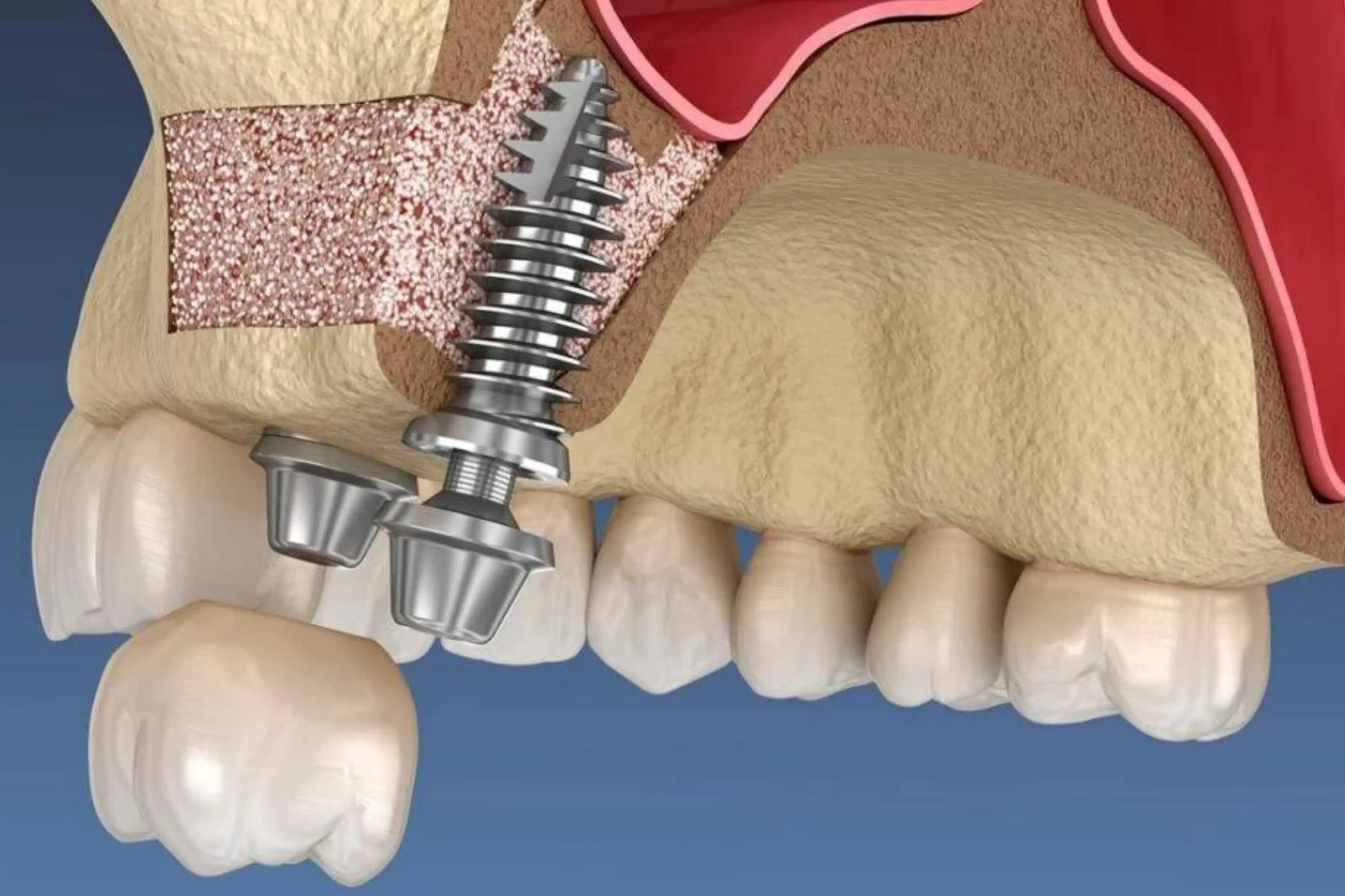 Sinus Lift 