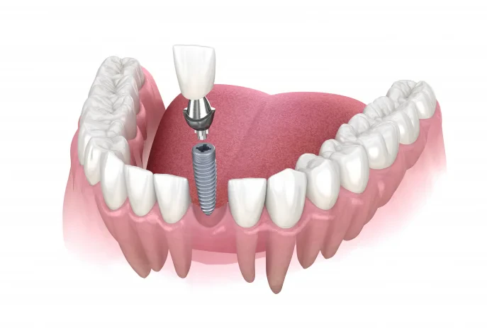 Prix des implants dentaires en Turquie en 2026 : guide détaillé des coûts
