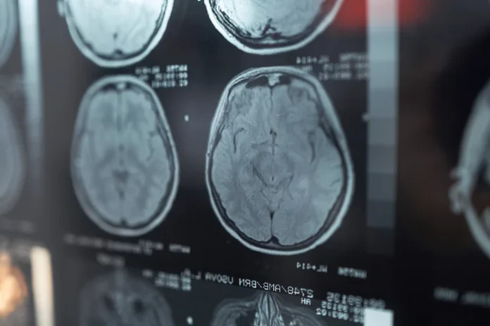 Diagnostic et traitement des maladies neurologiques en Turquie