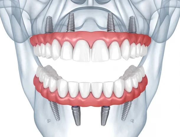 All-on-4 vs All-on-6 Dental Implants: What Are the Differences? | Clinicly