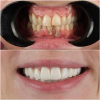 Smile Aesthetics - Hollywood Smile
