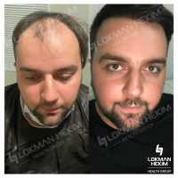 DHI Hair Transplantation