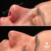 Rhinoplasty