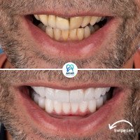 Facing - Smile Design - Hollywood Smile